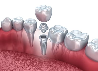 インプラント治療とは